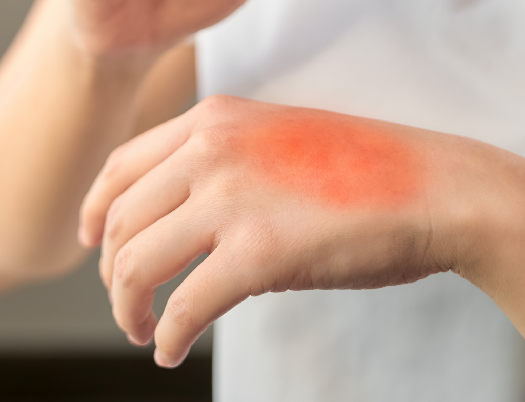 How to Avoid Ice Burn When Treating an Injury