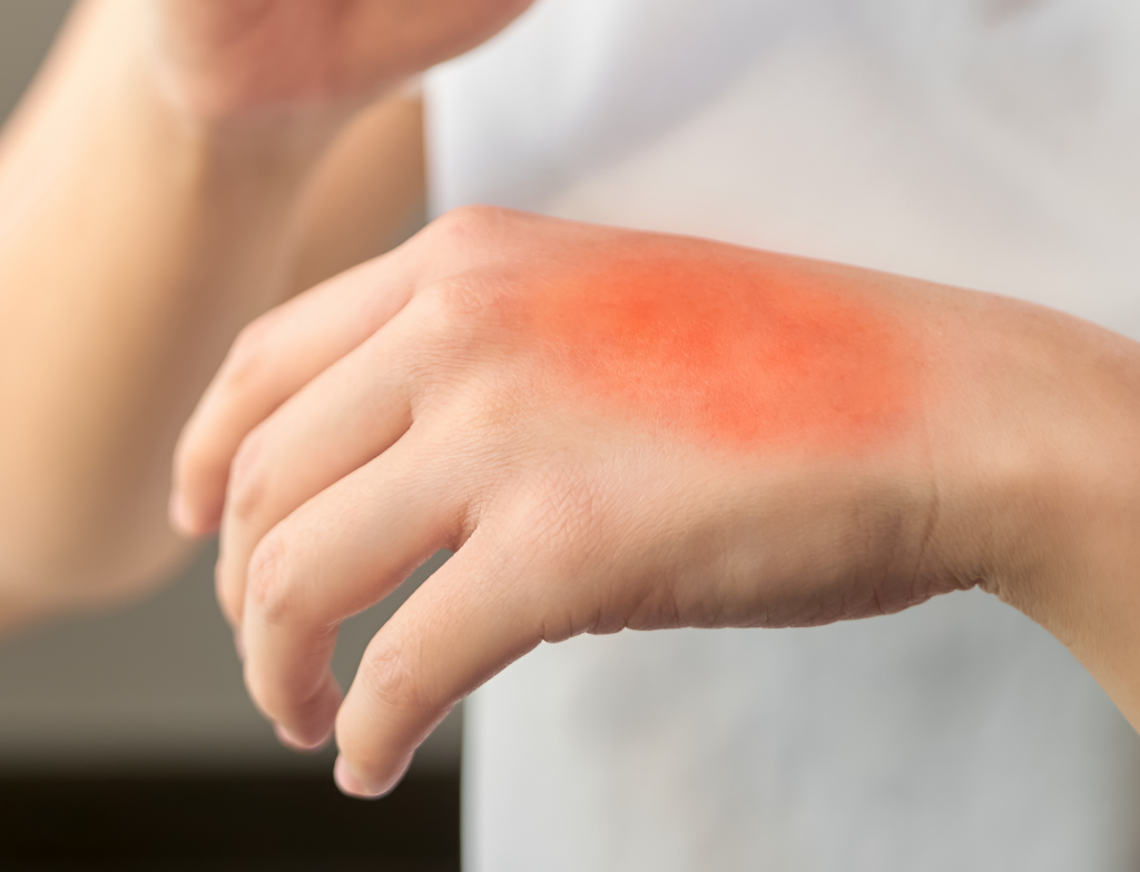 Myth Busters: Ice is the best way to relieve pain from a burn – The ...