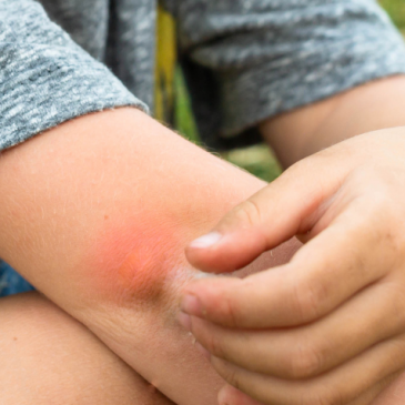 Preventing and Treating Bug Bites￼